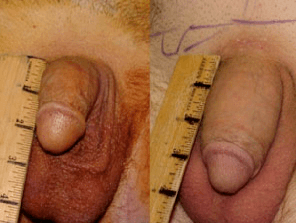 लिपोफिलिंग और जेल प्रत्यारोपण से पहले और बाद में